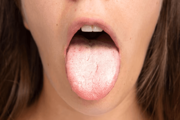 Cracks In Tongue