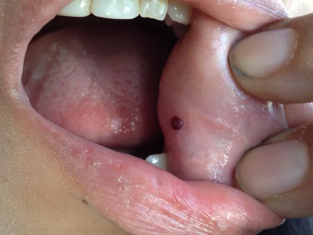 Blood Blister In Mouth