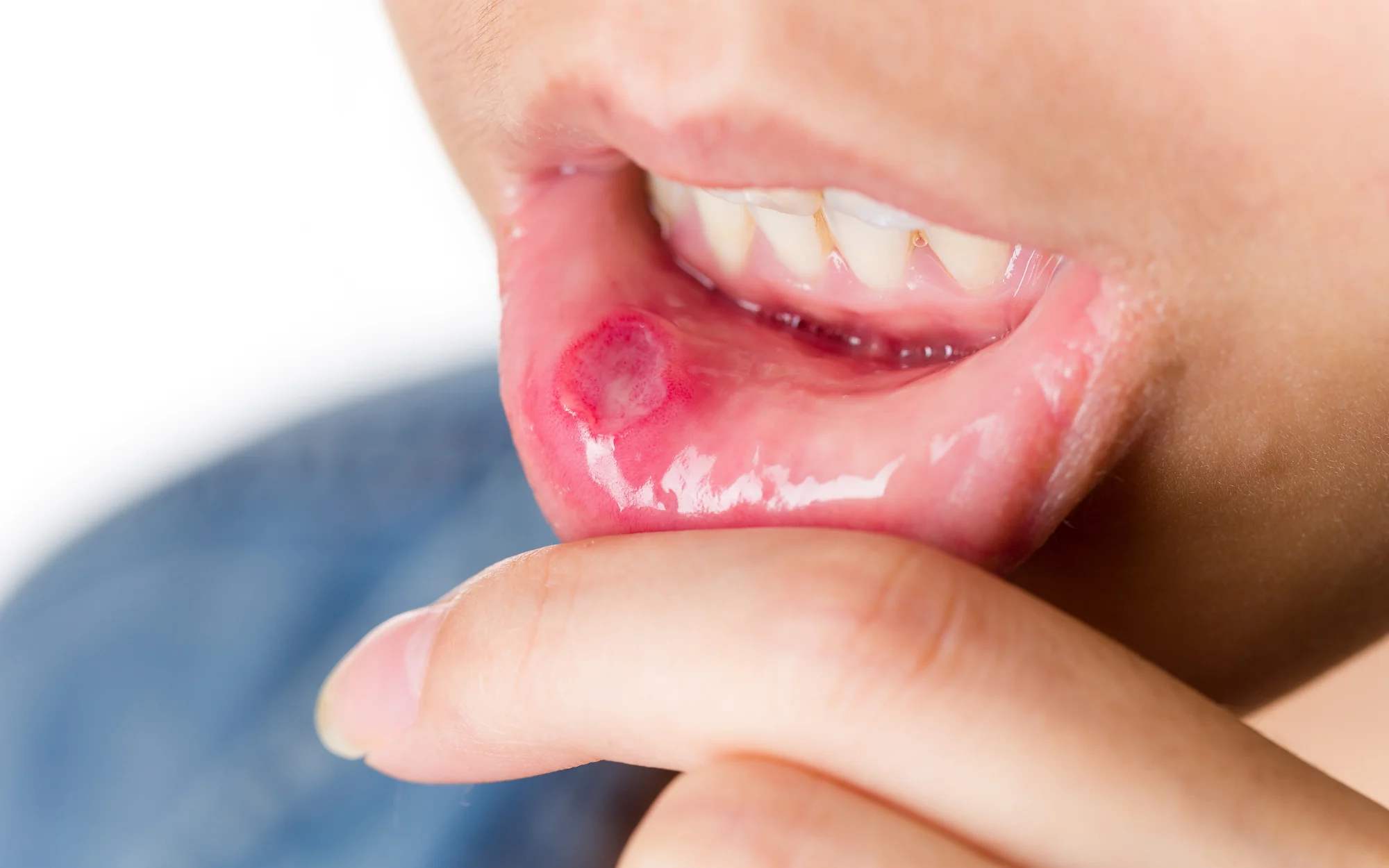 Canker Sore Vs Cancer How To Know