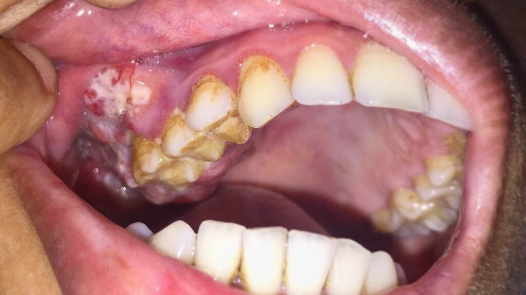 Oral Cancer