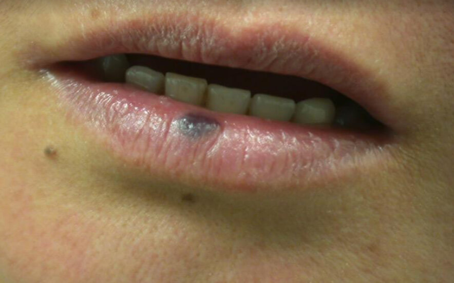 Blood Blister In Mouth, Cause, Treatments, Precaution