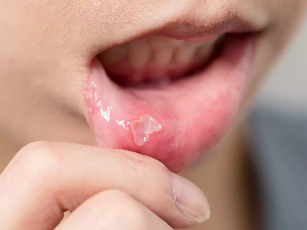 first stage of oral cancer