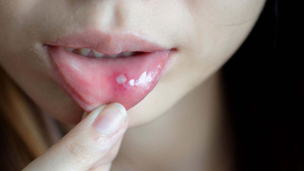 serious canker sore
