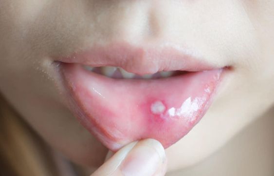 How Can You Heal A Canker Sore Fast