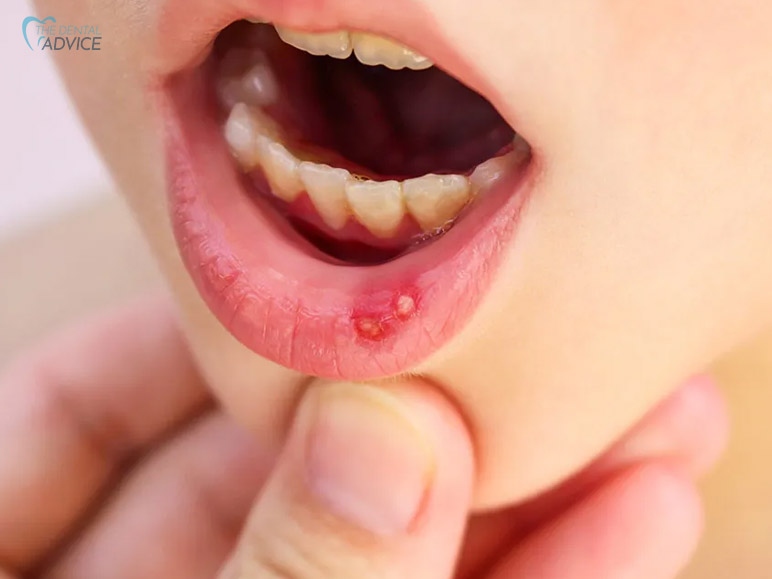 How To Treat Canker Sores In Kids?