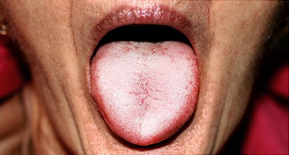 Oral Thrusting Infection