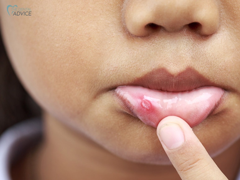 What Are The Common Symptoms Of Canker Sores