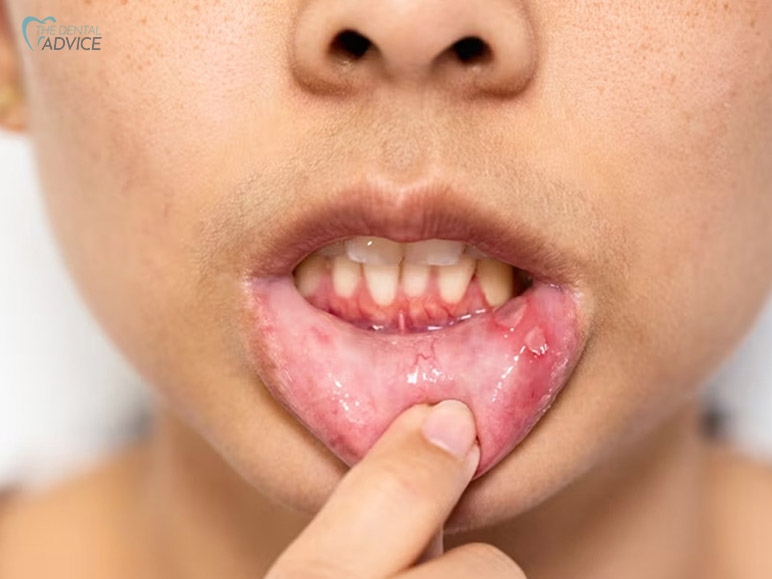 What Causes Canker Sores In Kids