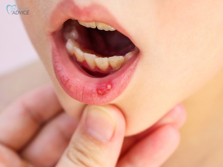 What Is Canker Sores Among Children?