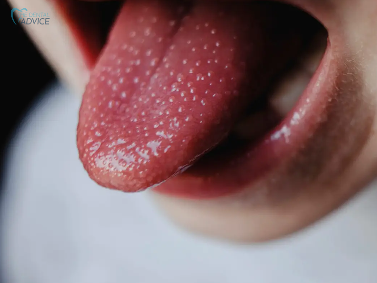 What Tounge Spots Mean_