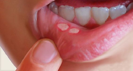 what causes canker sores in kids