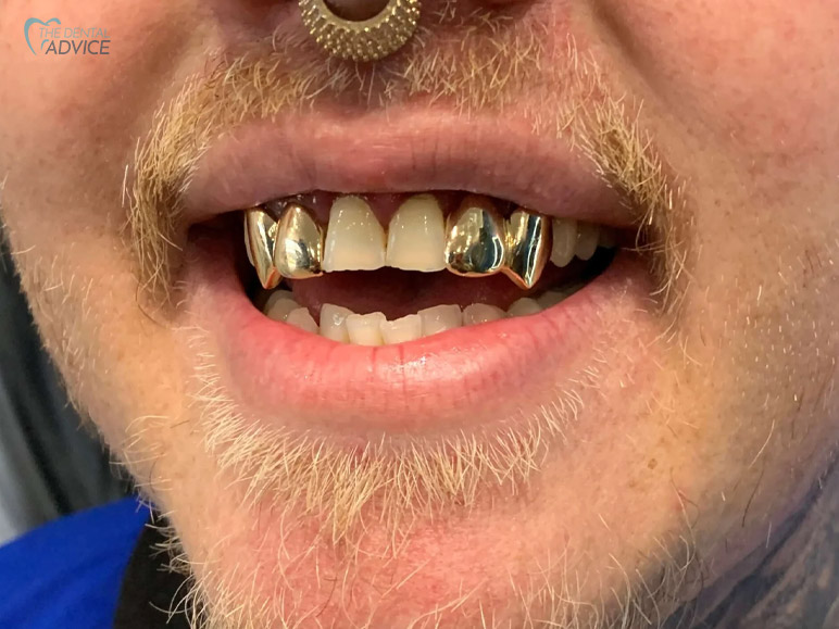 What Are Teeth Grillz?