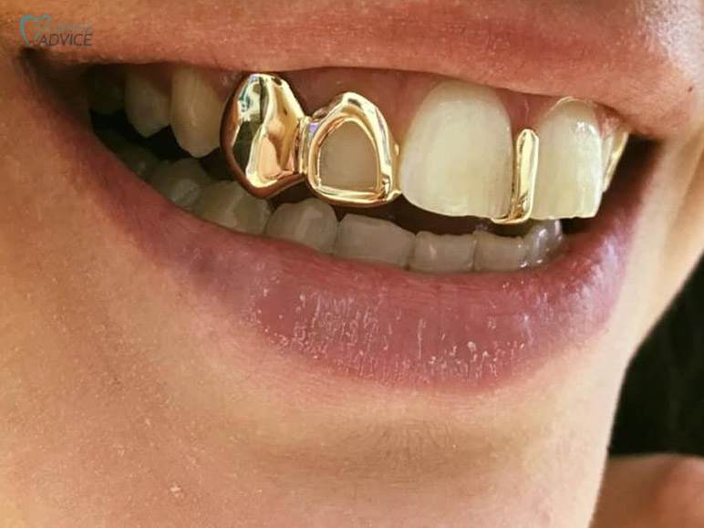 Are Grillz Bad For Your Teeth? Bottom Line