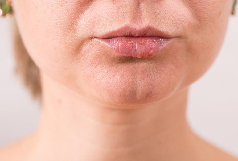 The Basics of White Spots on Lips