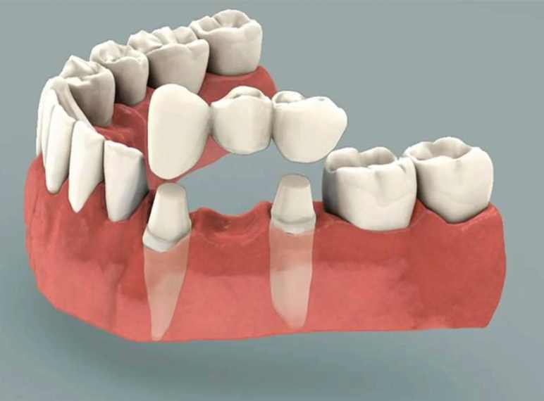 Types Of Dental Bridge