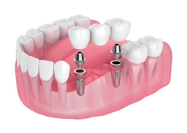 Implant Supported Bridge 